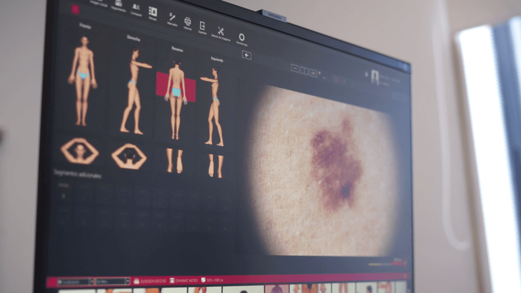 Dermatoscopía digital: la tecnología más avanzada para el diagnóstico de cáncer de piel llegó a Hospital Privado