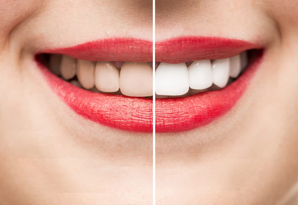 Antiaging dental: Qué es y cuándo es recomendable
